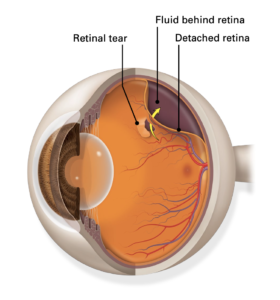 detached retina